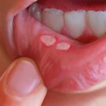 What are canker sores or mouth sores and how to cure them with natural remedies