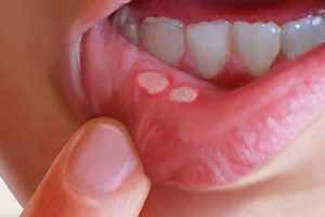 What are canker sores or mouth sores and how to cure them with natural remedies