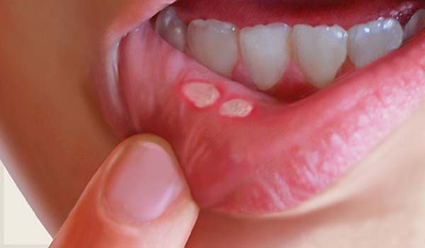 What are canker sores or mouth sores and how to cure them with natural remedies
